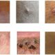 A picture made available by the UK Health Security Agency showing a range of monkeypox lesions